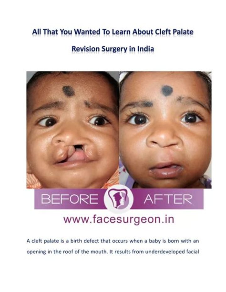Cleft Palate Revision Surgery in India All That You Wanted to Know