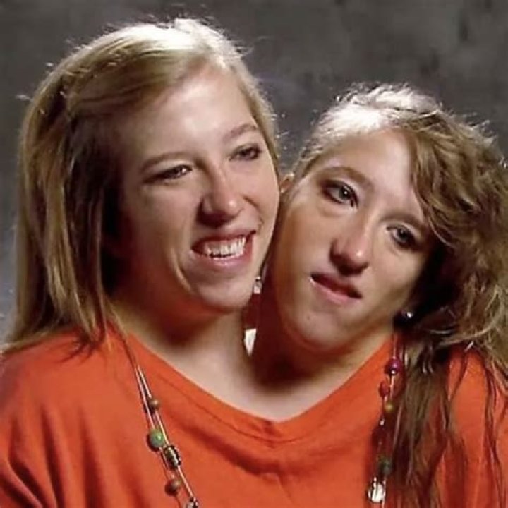 Conjoined Twins Abby and Brittany Hensel Decide on Procreation