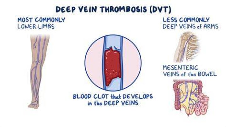 Deep vein thrombosis The Vein Lab