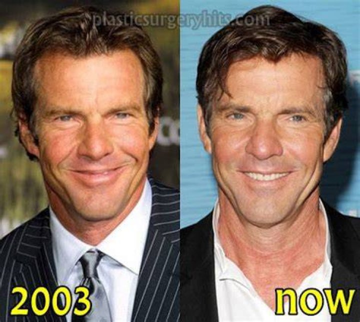 Dennis Quaid Plastic Surgery Botox, Eyelid Surgery, Before and After