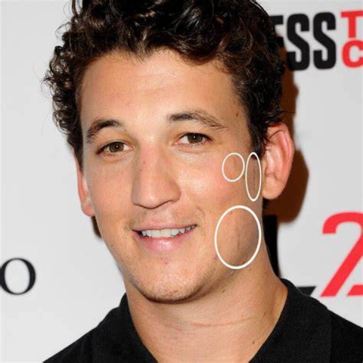 How Did Miles Teller Get His Scars? The 'Fantastic Four' Star Has A Sad