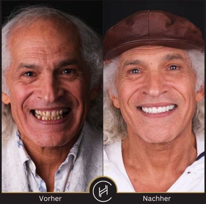 Joe Burrow Veneers vorher und nachher Neue Z&auml;hne bekommen, Joe Burrow