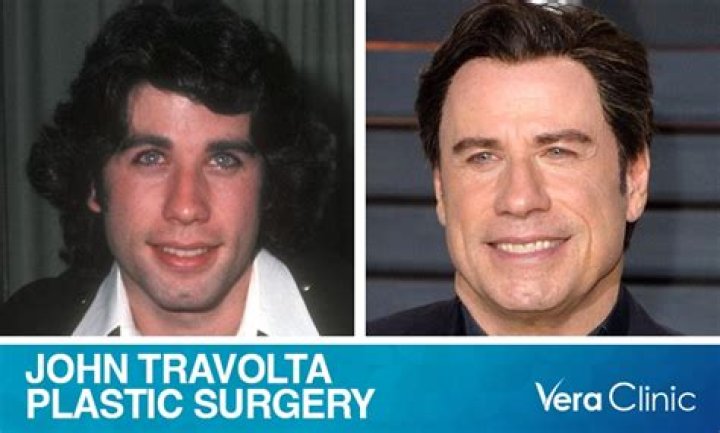 John Travolta Plastic Surgery Facelift, Botox, Hair transplant