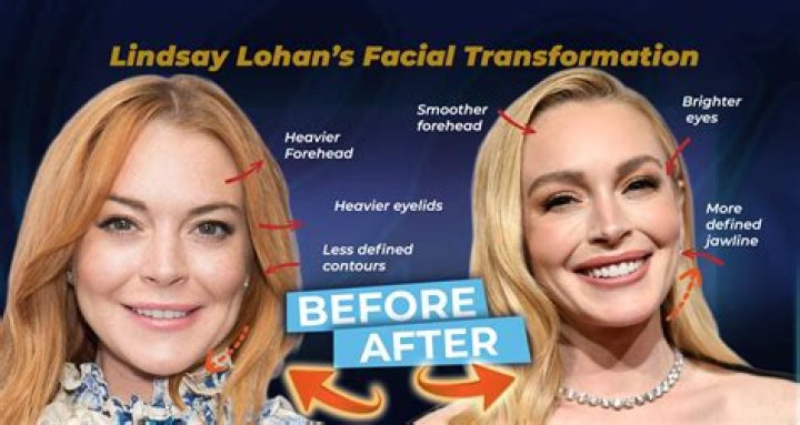 Lindsay Lohan Plastic Surgery An Improvement?