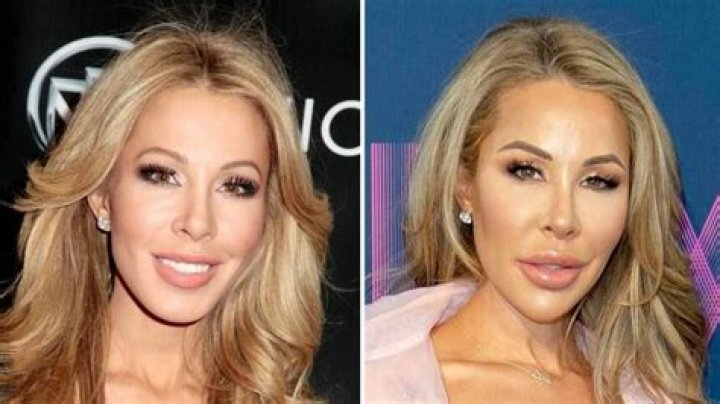 Lisa Hochstein Surgery Lisa Hochstein Before And After TRAN HUNG DAO