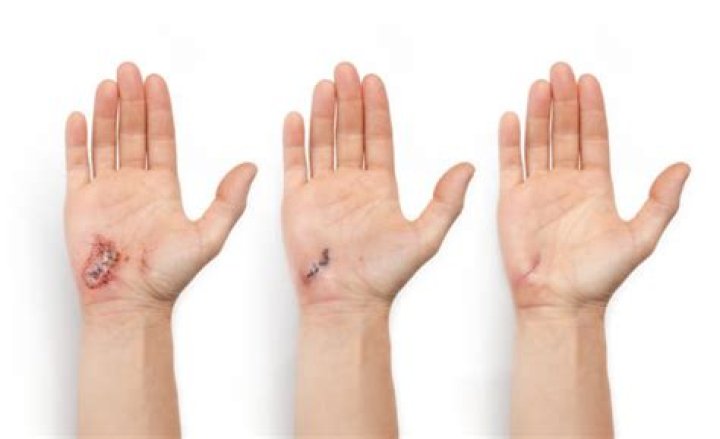Right after I healed from my kidney transplant surgery, I saw a How
