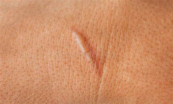 Scar On Human Skin Scar Or Scar After Kidney Surgery RoyaltyFree Stock