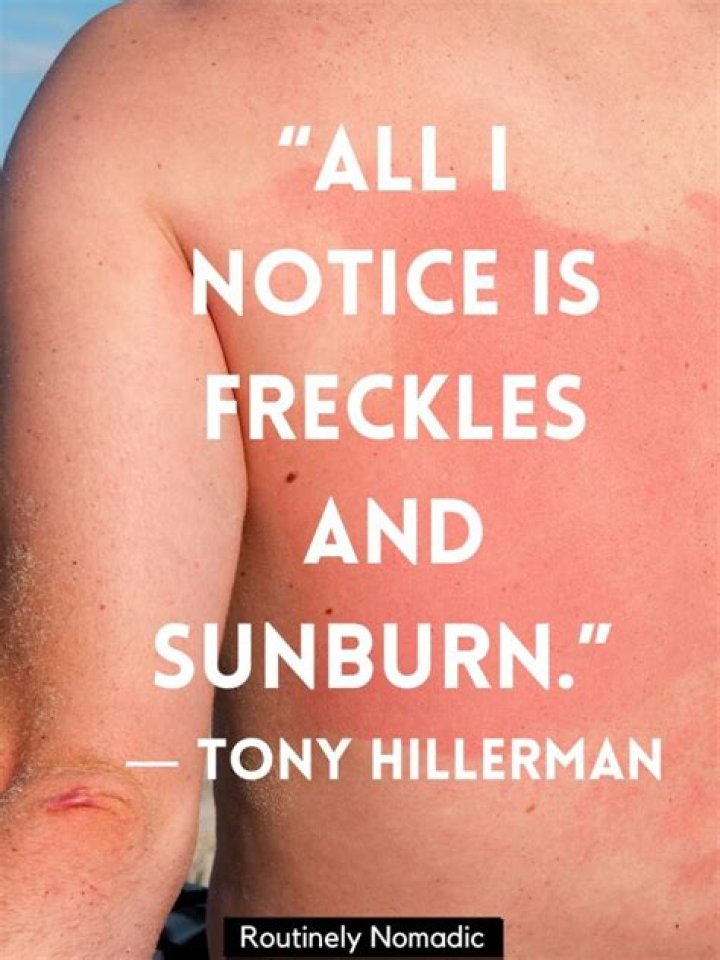 The Best Funny Sunburn Quotes Home, Family, Style and Art Ideas