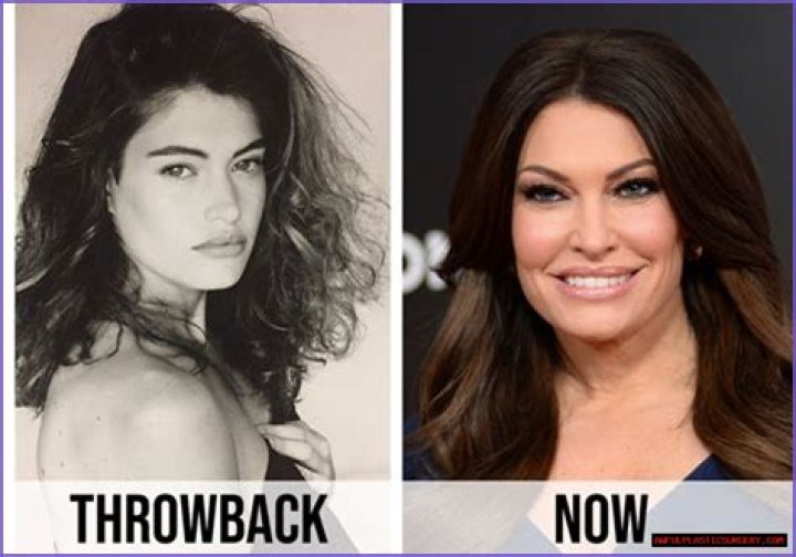 Unveiling The Transformations: Kimberly Guilfoyle's Plastic Surgeries