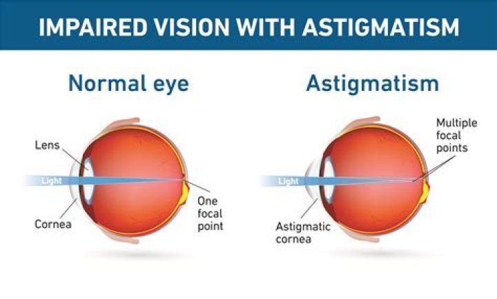 What Is Astigmatism & Everything You Need to Know — UNIQSO