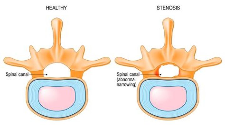What Is Spinal Stenosis And How Can It Be Treated? Homewood